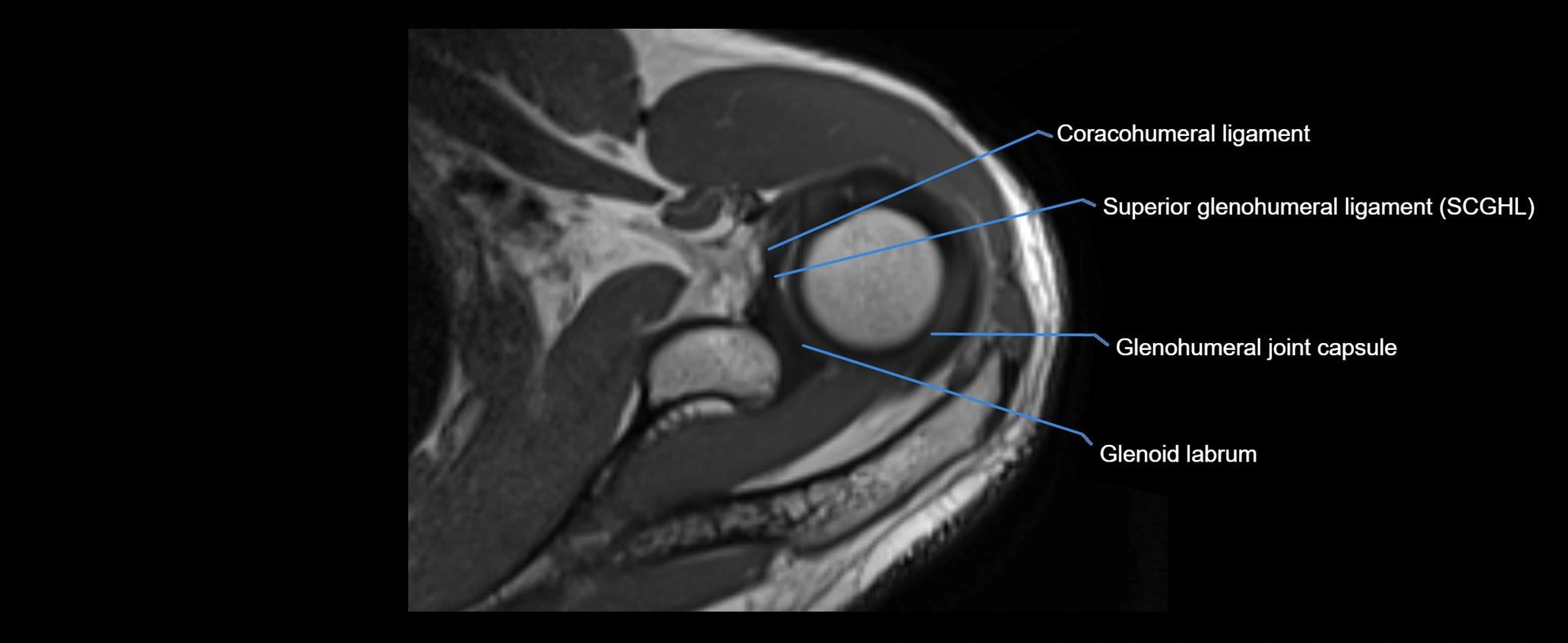 shoulder ligaments axial 3d 3t mri image-img-00005-00046.webp